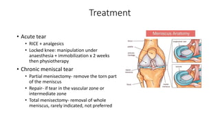 Treatment
• Acute tear
• RICE + analgesics
• Locked knee: manipulation under
anaesthesia + immobilization x 2 weeks
then physiotherapy
• Chronic meniscal tear
• Partial menisectomy- remove the torn part
of the meniscus
• Repair- if tear in the vascular zone or
intermediate zone
• Total menisectomy- removal of whole
meniscus, rarely indicated, not preferred
 