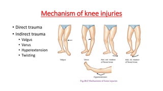 Mechanism of knee injuries
• Direct trauma
• Indirect trauma
• Valgus
• Varus
• Hyperextension
• Twisting
 