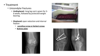 • Treatment
• Unicondylar fractures
• Undisplaced : long leg cast is given for 3-
6 weeks, followed by protected weight
bearing.
• Displaced: open reduction and internal
fixation
• cancellous screw or Herbert screws
• Buttress plate
 