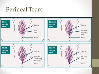 Perineal Tears
 