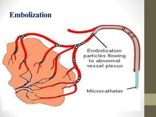 Embolization
 