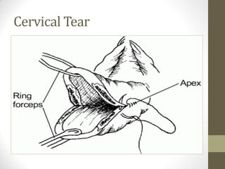 Cervical Tear
 