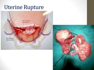 Uterine Rupture
 