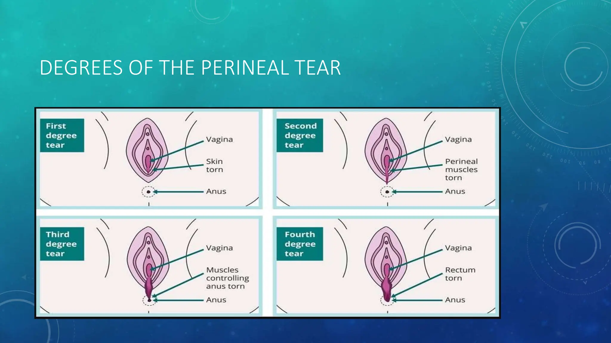 injuries-to-birth-canal-pptx-by-devanand-hurgule-pptx