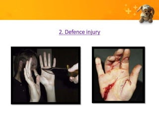 Injury (Forensic science) | PPTX