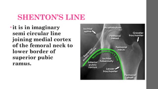 Stenton Line injury around the hip. #Hip joint pptt .pptx