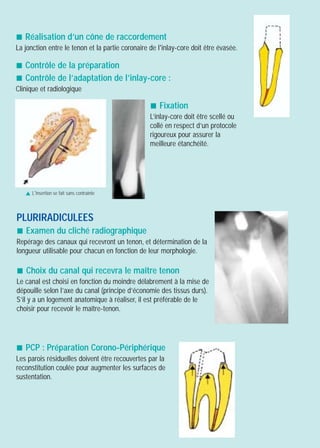 ! Réalisation d’un cône de raccordement
La jonction entre le tenon et la partie coronaire de l'inlay-core doit être évasée.
! Contrôle de la préparation
! Contrôle de l’adaptation de l’inlay-core :
Clinique et radiologique
PLURIRADICULEES
! Examen du cliché radiographique
Repérage des canaux qui recevront un tenon, et détermination de la
longueur utilisable pour chacun en fonction de leur morphologie.
! Choix du canal qui recevra le maître tenon
Le canal est choisi en fonction du moindre délabrement à la mise de
dépouille selon l’axe du canal (principe d’économie des tissus durs).
S’il y a un logement anatomique à réaliser, il est préférable de le
choisir pour recevoir le maître-tenon.
! Fixation
L’inlay-core doit être scellé ou
collé en respect d’un protocole
rigoureux pour assurer la
meilleure étanchéité.
! PCP : Préparation Corono-Périphérique
Les parois résiduelles doivent être recouvertes par la
reconstitution coulée pour augmenter les surfaces de
sustentation.
L'insertion se fait sans contrainte!
 