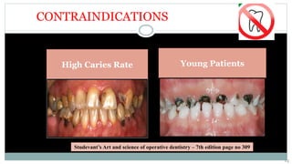CONTRAINDICATIONS
High Caries Rate Young Patients
Studevant’s Art and science of operative dentistry – 7th edition page no 309
14
 