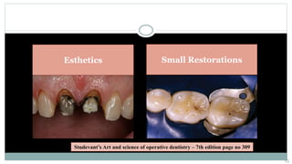 Esthetics Small Restorations
Studevant’s Art and science of operative dentistry – 7th edition page no 309
15
 