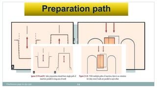 Preparation path
Preparation should have single insertion path
opposite to the occlusal load and parallel to the
long axis of tooth. This helps in retention of
the restoration.
Charbeneau page no 351-359 24
 