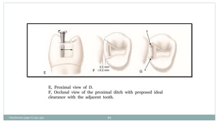 E, Proximal view of D.
F, Occlusal view of the proximal ditch with proposed ideal
clearance with the adjacent tooth.
Charbeneau page no 351-359 61
 