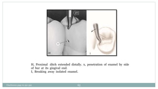 H, Proximal ditch extended distally. x, penetration of enamel by side
of bur at its gingival end.
I, Breaking away isolated enamel.
Charbeneau page no 351-359 65
 