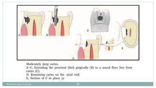 Moderately deep caries.
A–C, Extending the proximal ditch gingivally (B) to a sound floor free from
caries (C).
D, Remaining caries on the axial wall.
E, Section of C in plane yy
Charbeneau page no 351-359 68
 