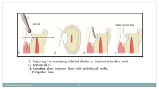F, Removing the remaining infected dentin. c, inserted retraction cord.
G, Section of F.
H, Inserting glass ionomer base with periodontal probe.
I, Completed base.
Charbeneau page no 351-359 70
 