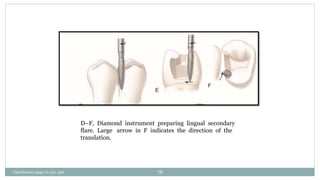 D–F, Diamond instrument preparing lingual secondary
flare. Large arrow in F indicates the direction of the
translation.
Charbeneau page no 351-359 76
 