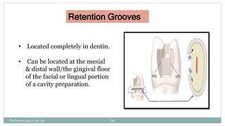 Retention Grooves
• Located completely in dentin.
• Can be located at the mesial
& distal wall/the gingival floor
of the facial or lingual portion
of a cavity preparation.
Charbeneau page no 351-359 79
 