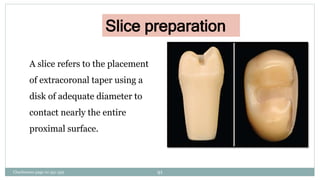 Slice preparation
A slice refers to the placement
of extracoronal taper using a
disk of adequate diameter to
contact nearly the entire
proximal surface.
Charbeneau page no 351-359 91
 