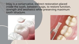 Function Loader Inlay inlay onlay.pptxSampleMAXILOFACIALSampleMAXILOFACIAL | PPTX