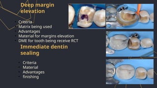 Matrice Rct Inlay onlay and overlay in restorative dentistry | PPTX