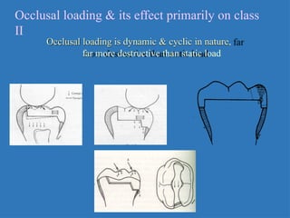 inlay ppt for class 1 and class 2 indirect | PPTX