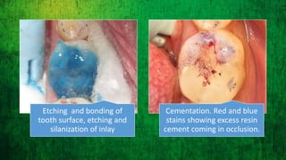 Inlay cavity preparation by direct and indirect method for the ...