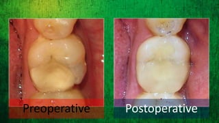 Inlay cavity preparation by direct and indirect method for the ...