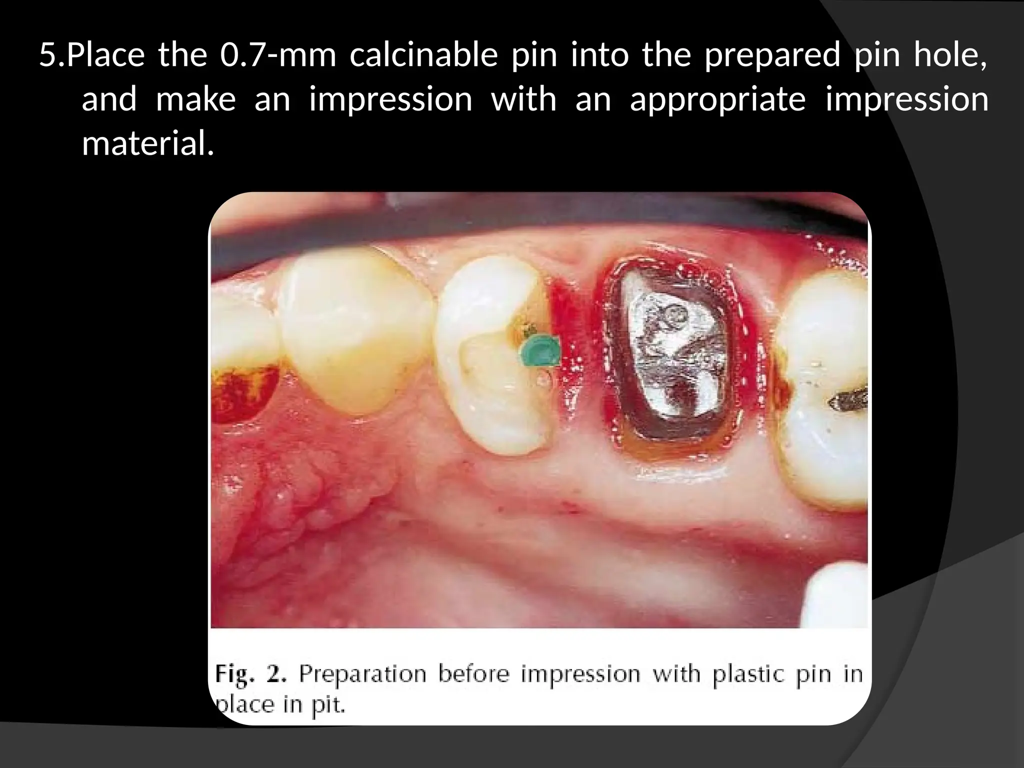 5.Place the 0.7-mm calcinable pin into the prepared pin hole,
and make an impression with an appropriate impression
material.
 