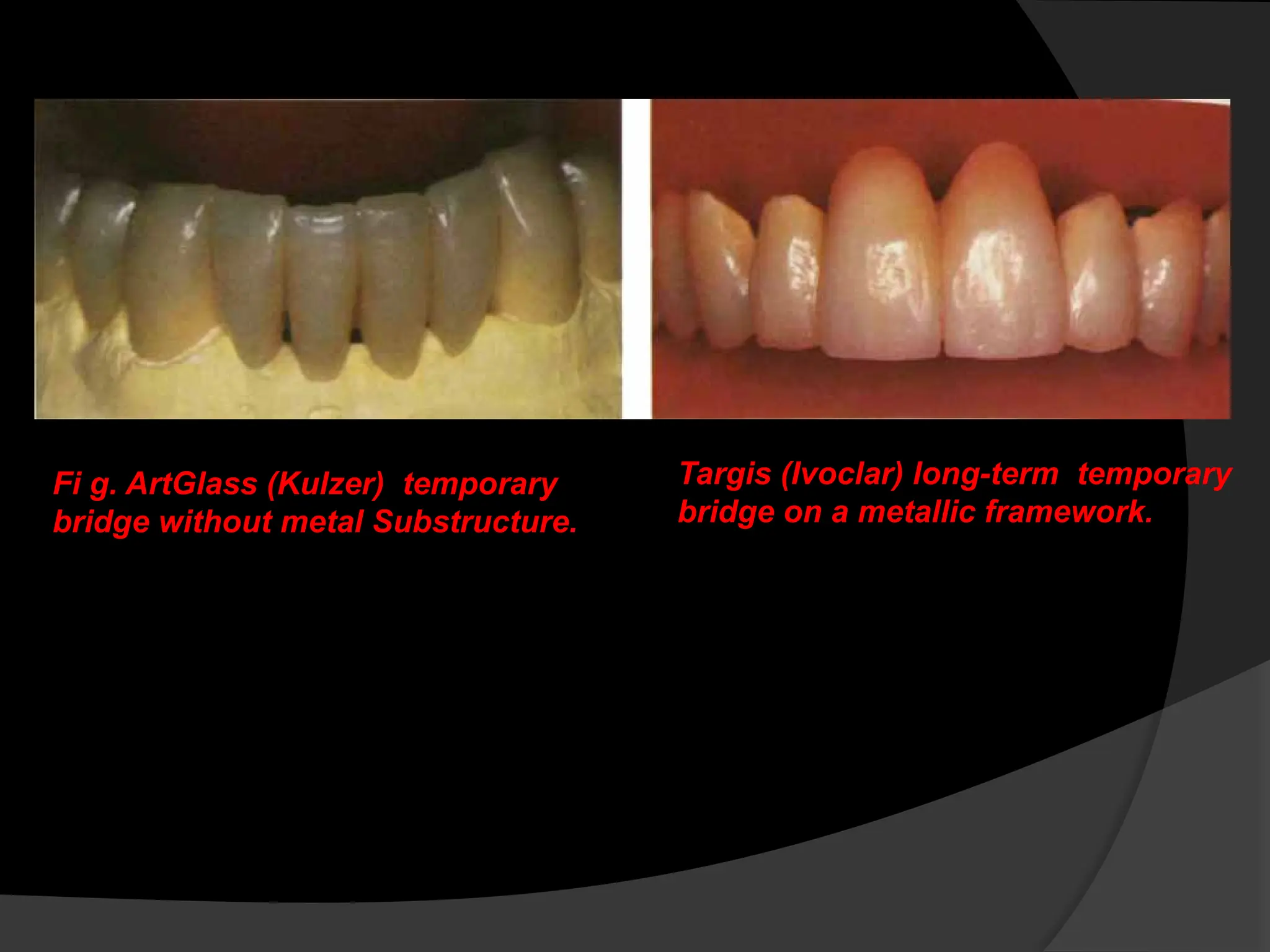 Fi g. ArtGlass (Kulzer) temporary
bridge without metal Substructure.
Targis (Ivoclar) long-term temporary
bridge on a metallic framework.
 