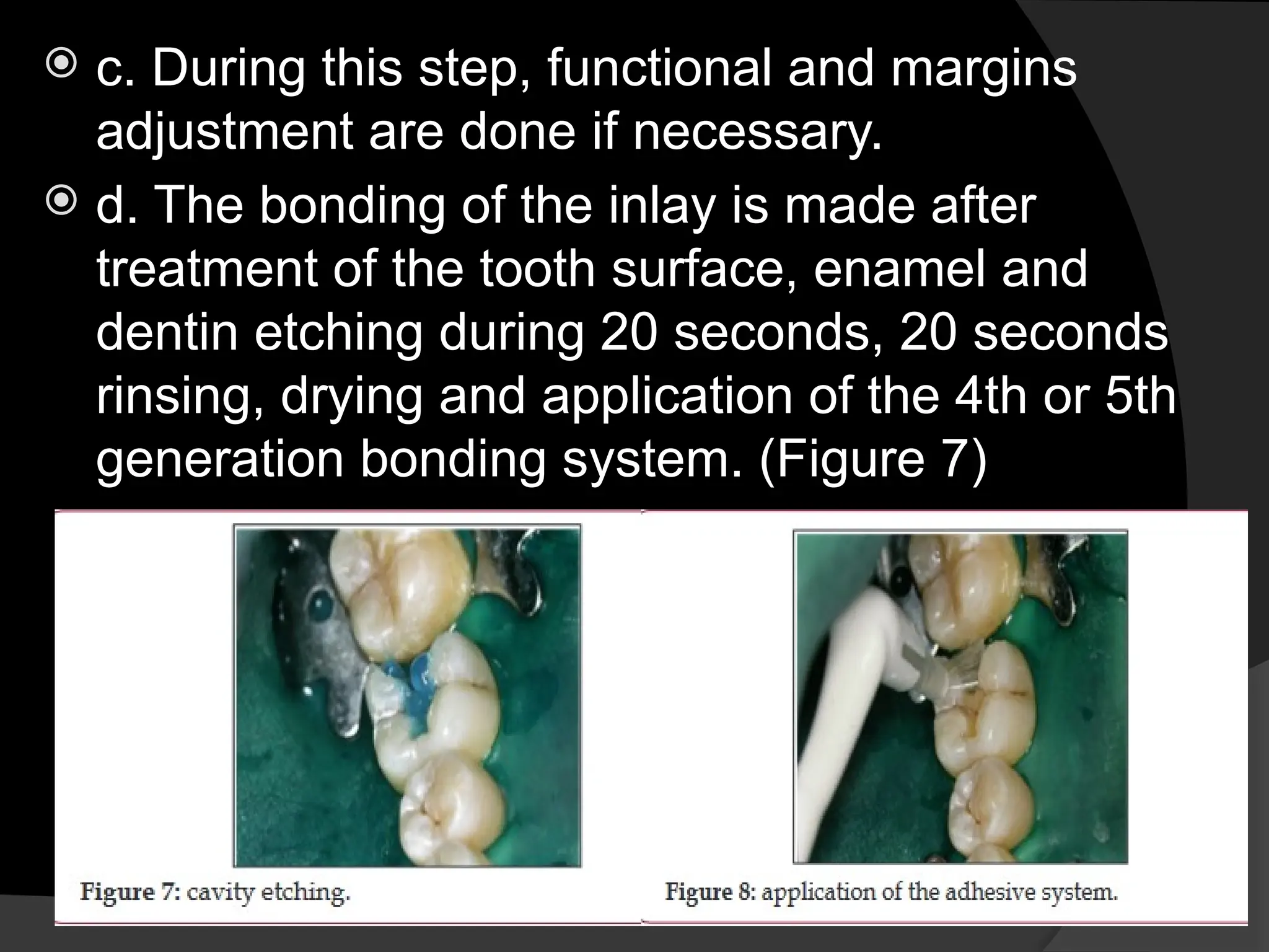  c. During this step, functional and margins
adjustment are done if necessary.
 d. The bonding of the inlay is made after
treatment of the tooth surface, enamel and
dentin etching during 20 seconds, 20 seconds
rinsing, drying and application of the 4th or 5th
generation bonding system. (Figure 7)
 