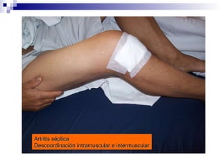 Artritis séptica Descoordinación intramuscular e intermuscular 
