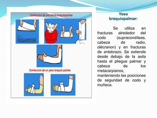 inmovilizacion-pptx