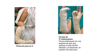 inmovilizaciones javier.pptx
