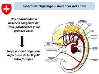 Sindrome Digeorge – Ausencia del Timo
Hay anormalidad o
ausencia congénita del
Timo, paratiroides y sus
grandes vasos

Surge por embriogénesis
defectuosa de la 3ª y 4ª
Bolsa faríngea

 