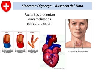 Sindrome Digeorge – Ausencia del Timo
Pacientes presentan
anormalidades
estructurales en:

 