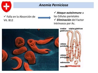 Anemia Perniciosa
 Falla en la Absorción de
Vit. B12

Resultado

Deterioro
en
la
eritropoyesis (anemia
megaloblástica)

 Ataque autoinmune a
las Células parietales
 Eliminación del Factor
Intrínseco por Ac.

 