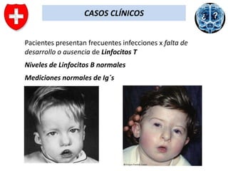 CASOS CLÍNICOS
Pacientes presentan frecuentes infecciones x falta de
desarrollo o ausencia de Linfocitos T
Niveles de Linfocitos B normales
Mediciones normales de Ig´s

 