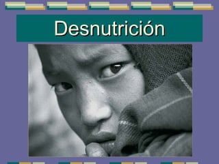 Desnutrición 