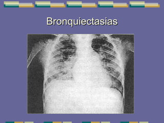 Bronquiectasias 