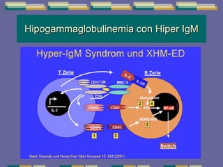 Hipogammaglobulinemia con Hiper IgM 