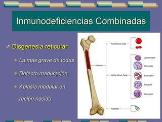 Inmunodeficiencias Combinadas Disgenesia reticular La más grave de todas  Defecto maduración Aplasia medular en recién nacido 