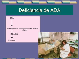 Deficiencia de ADA 