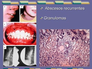 Abscesos recurrentes Granulomas 