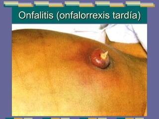 Onfalitis (onfalorrexis tardía) 