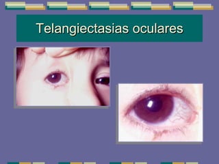 Telangiectasias oculares 
