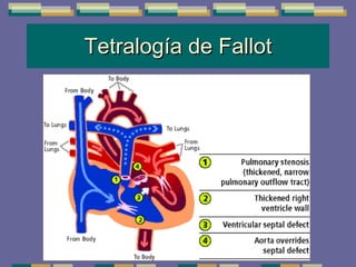 Tetralogía de Fallot 