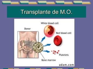 Transplante de M.O. 