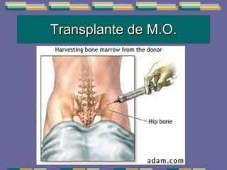 Transplante de M.O. 