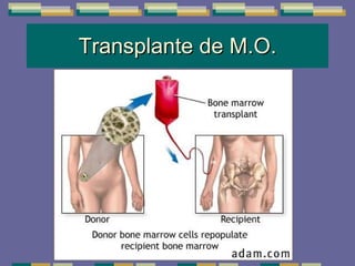 Transplante de M.O. 