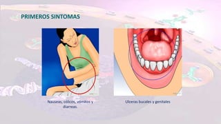PRIMEROS SINTOMAS
Nauseas, cólicos, vómitos y
diarreas.
Ulceras bucales y genitales
 