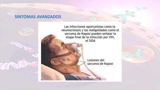 SINTOMAS AVANZADOS
 
